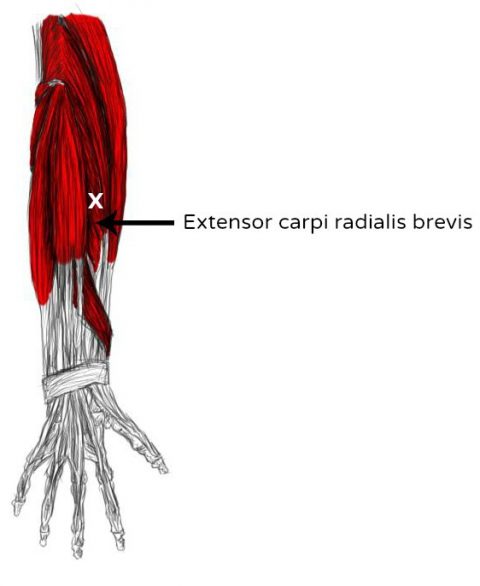 Muscle extenseur du carpe : ulnaire, radial, schéma